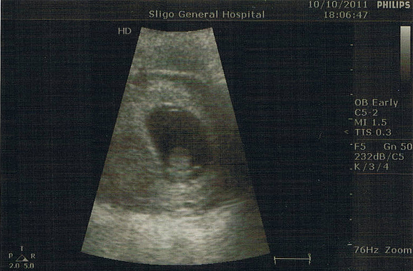 Baby im Bauch 3 - Ultraschallbild